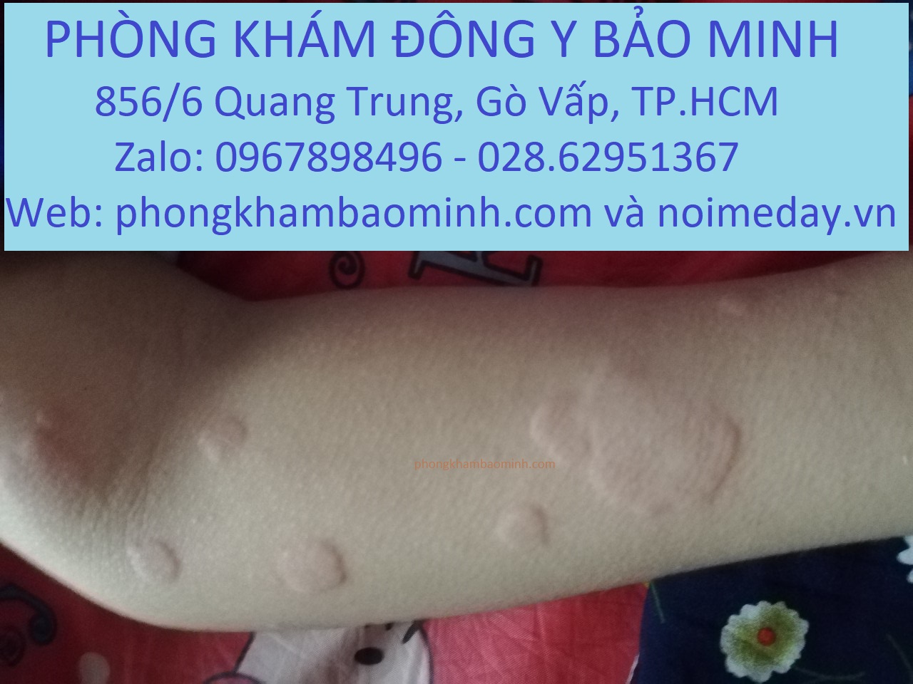 Nổi mề đay ban đêm